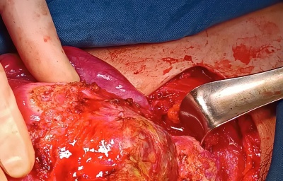 Phẫu thuật bảo tồn tử cung trên bệnh nhân thai bám sẹo mổ cũ xuyên cơ tử cung trên vết mổ 3 lần.